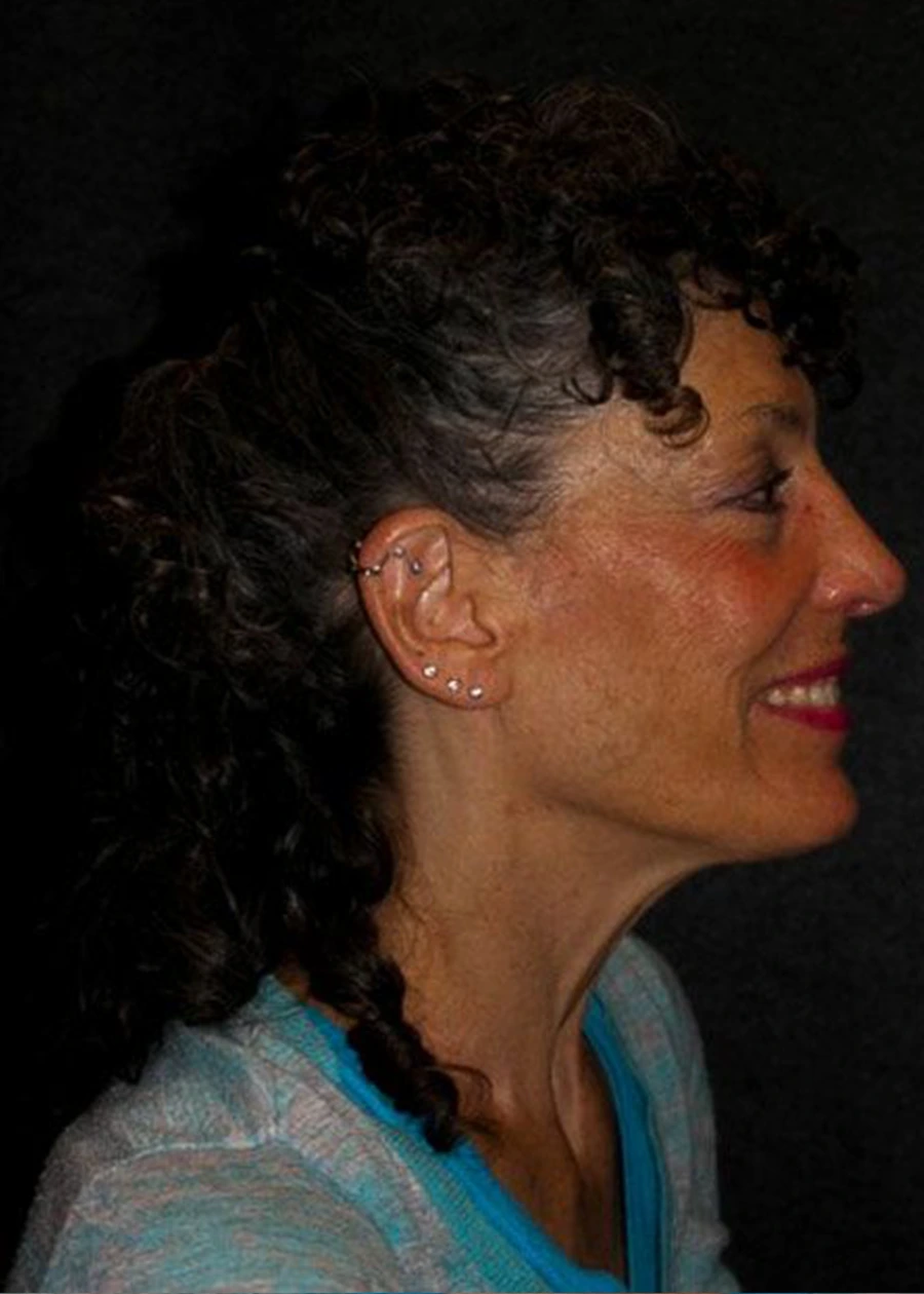 Rhinoplasty Patient 4 Set 2 After